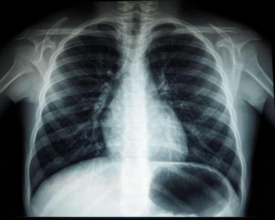 chest-x-ray-29.thumb.jpg.6577f25807e04753278351182be6bb64.jpg